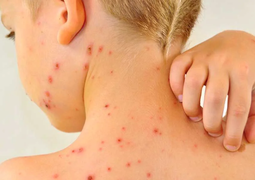 varicella-zoster